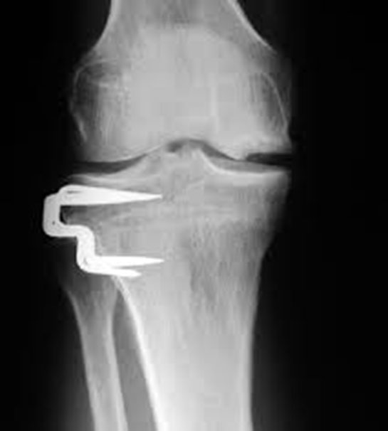 Dizde Kemik İliği Ödemi Belirtileri ve Tedavisi